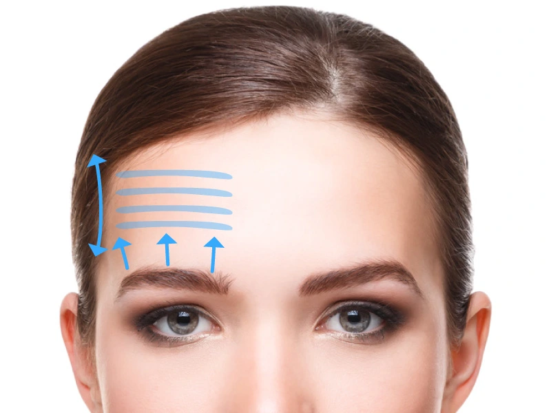 Lifting frontal Sevilla