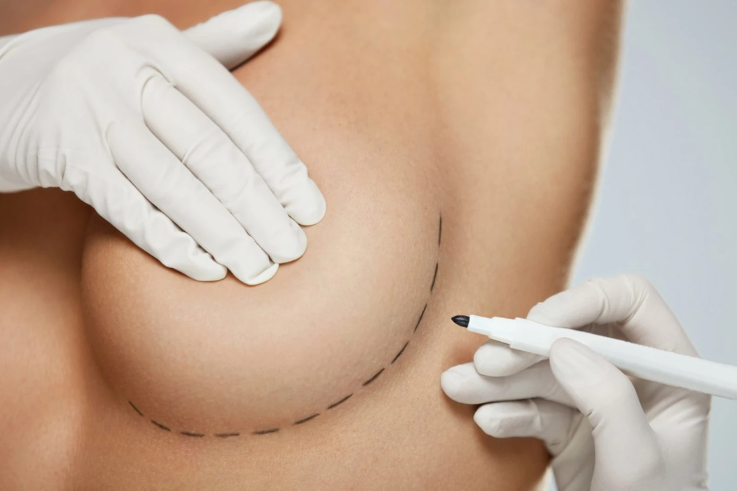 Me quedara cicatriz tras el aumento de pecho