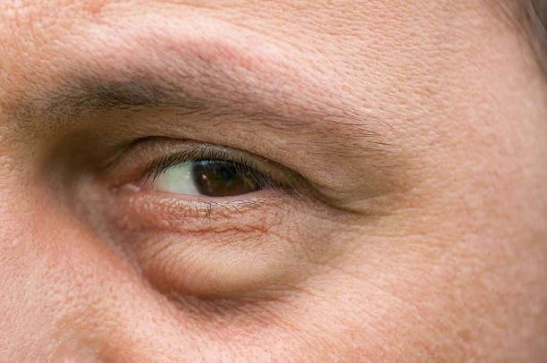 bolsas en los ojos por retencion de liquidos