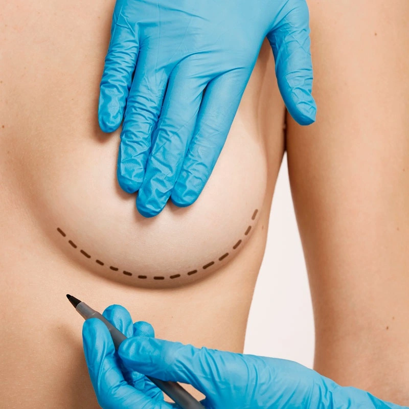 cicatriz-aumento-de-pecho