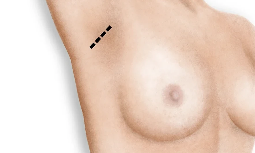 cicatriz-axilar-aumento-de-pecho