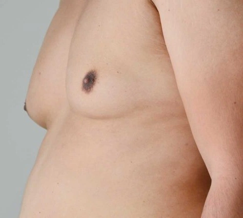 la-ginecomastia-desaparece-sola