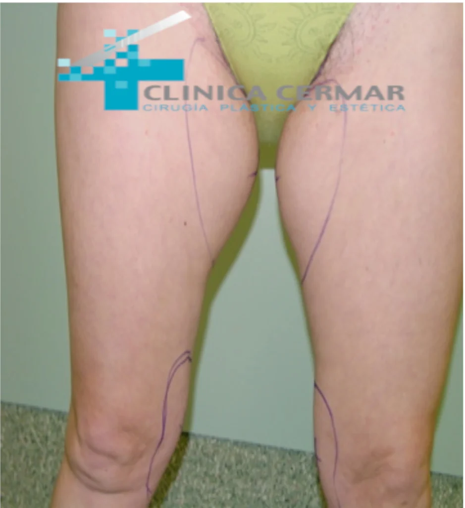 lifting de muslos antes 2