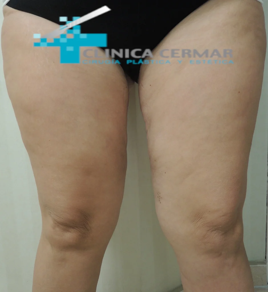 lifting de muslos despues 1