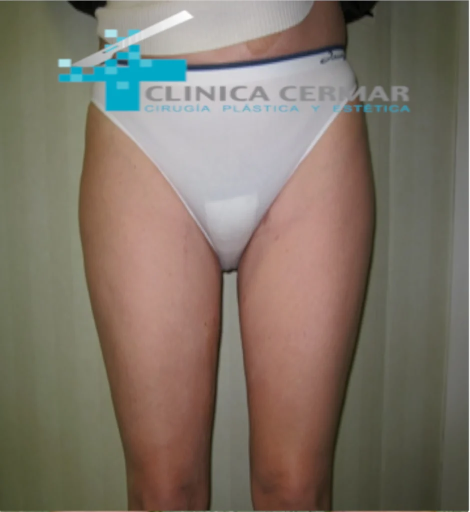 lifting de muslos despues 2