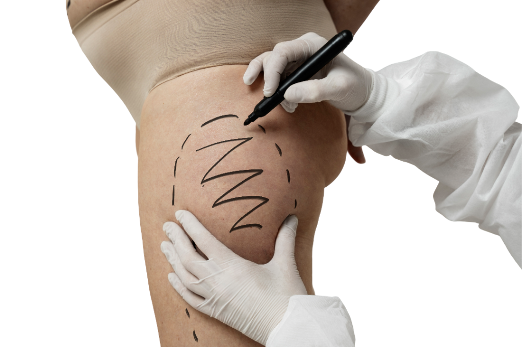 lo que el lifting de muslos no puede hacer