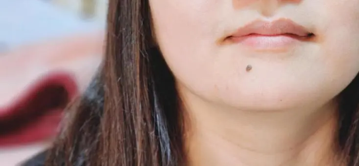 lunares-nevus-cara