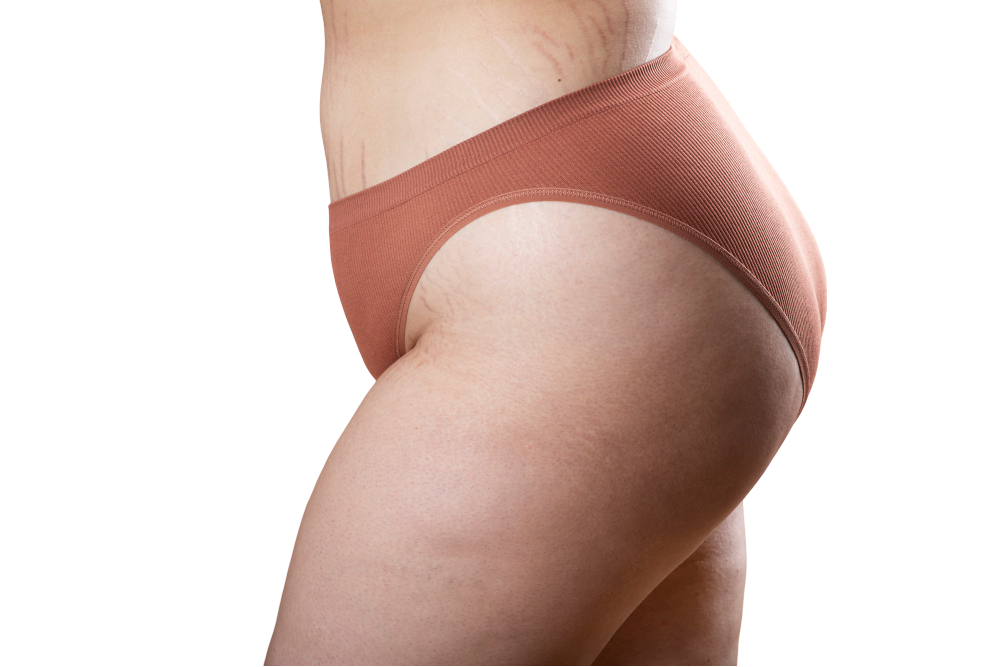 ventajas del lifting de muslos